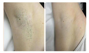 ГЕЛЬ-КРЕМ ДЛЯ ВИДАЛЕННЯ ВОЛОССЯ